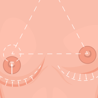 Mastopexia e Mamoplastia de aumento: entenda a diferença entre os procedimentos!