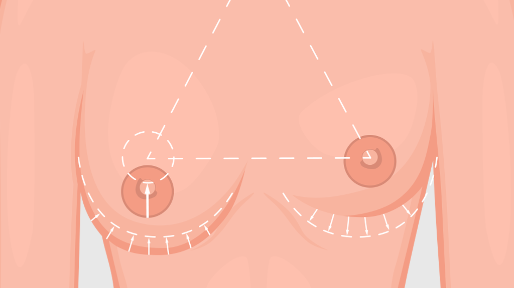 Mastopexia e Mamoplastia de aumento: entenda a diferença entre os procedimentos!