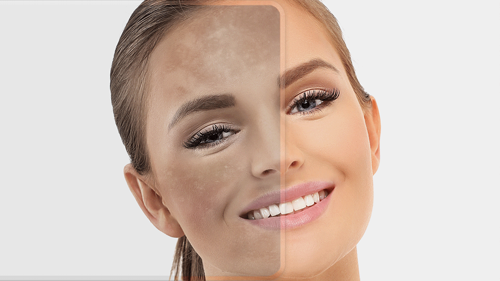 Tratamentos indicados para melasma